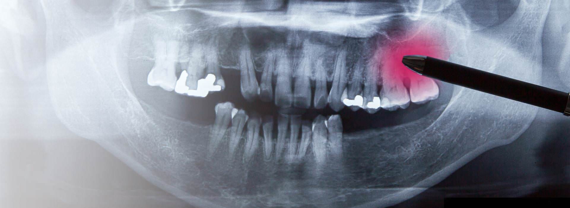 Störfeldsanierung: Röntgenaufnahme mit Zahnherd