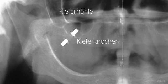 Knochenabbau im Oberkiefer