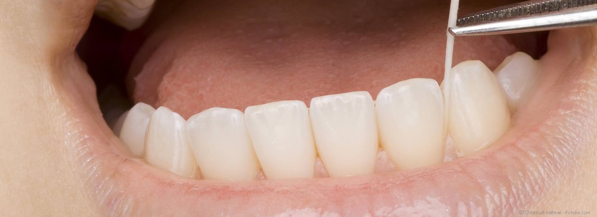 Orotox-Test: Scheiden tote und wurzelbehandelte Zähne Gifte aus?